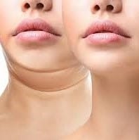 جراحی ساکشن غبغب ( تخلیه کامل چربی ناحیه غبغب)
