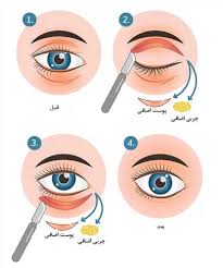 جراحی بلفاروپلاستی