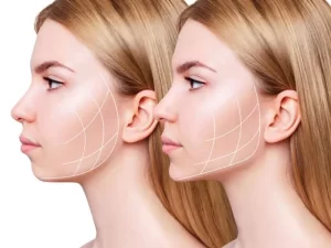 قبل و بعد جراحی بوکال فت (برداشتن چربی ناحیه زیرگونه و لپ)