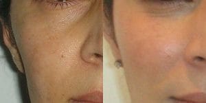Cheek fat injection