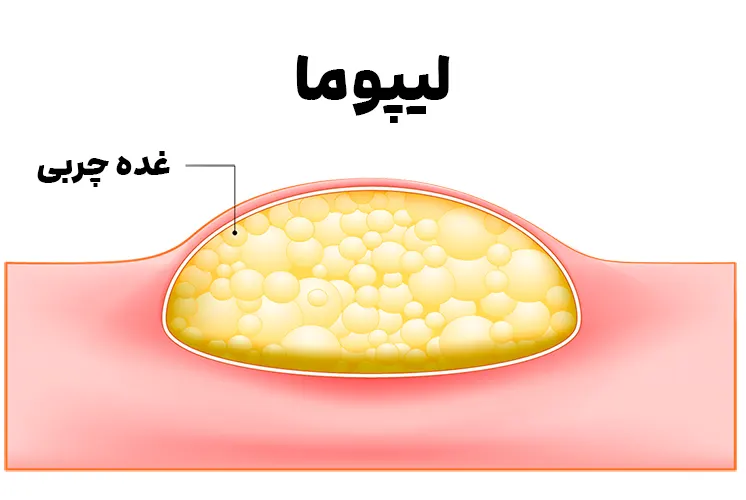 برداشتن توده چربی (لیپوم)