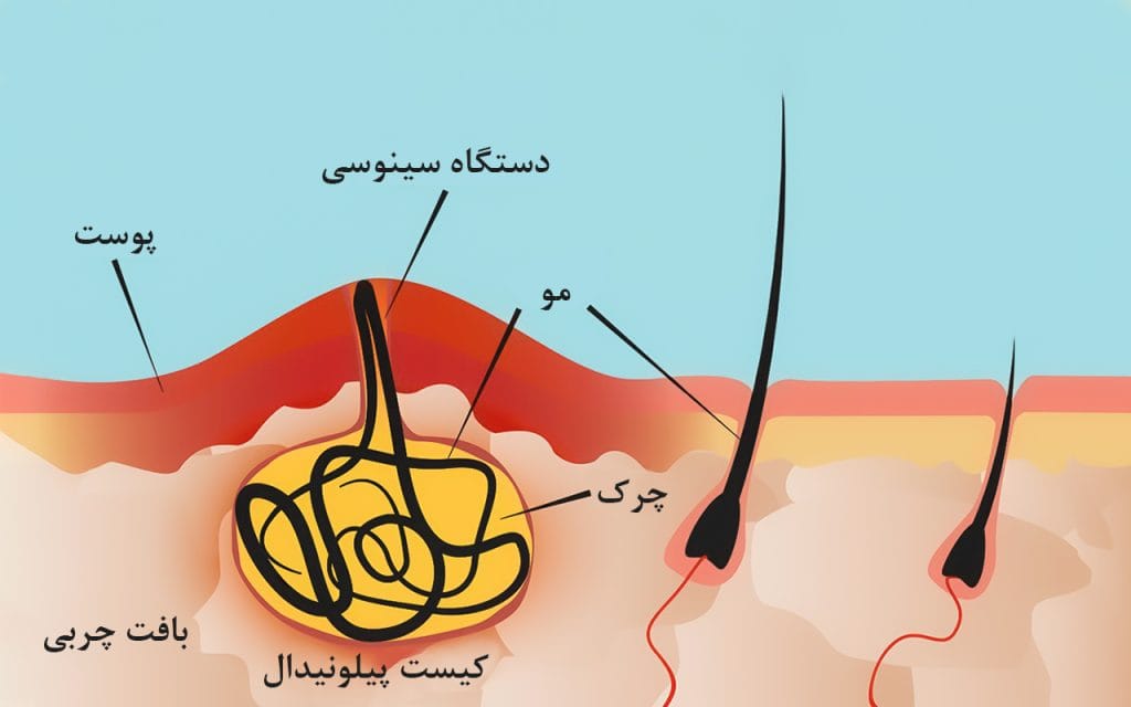 سینوس پایلونیدال